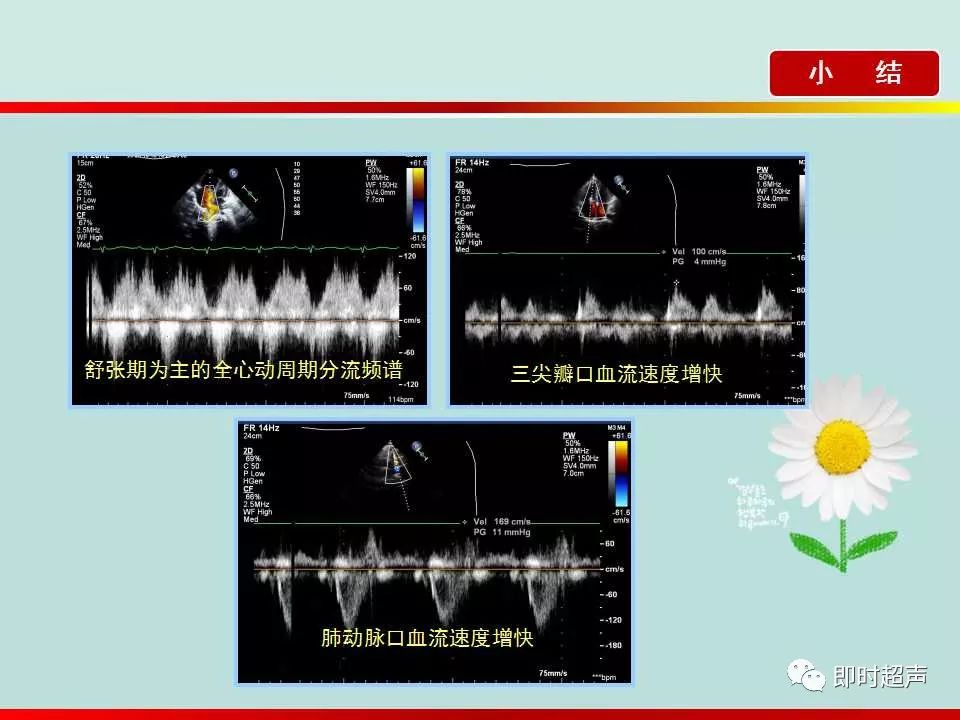 房间隔缺损的超声诊断