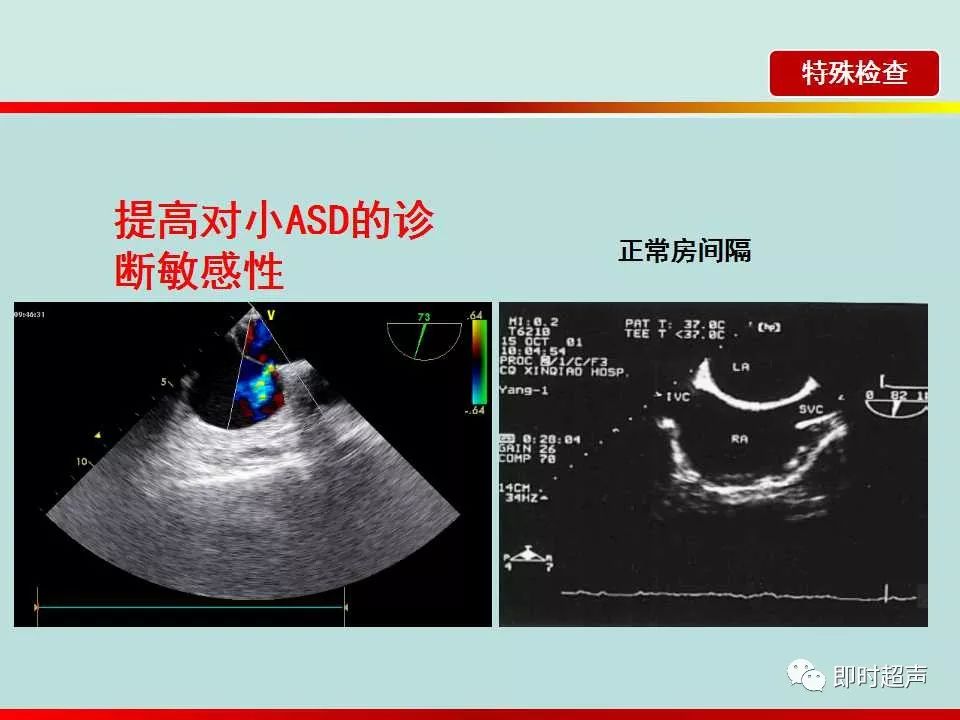 房间隔缺损的超声诊断