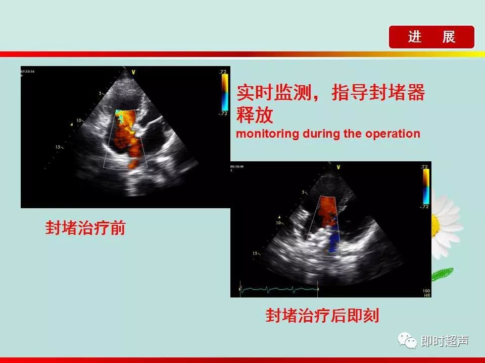 房间隔缺损的超声诊断