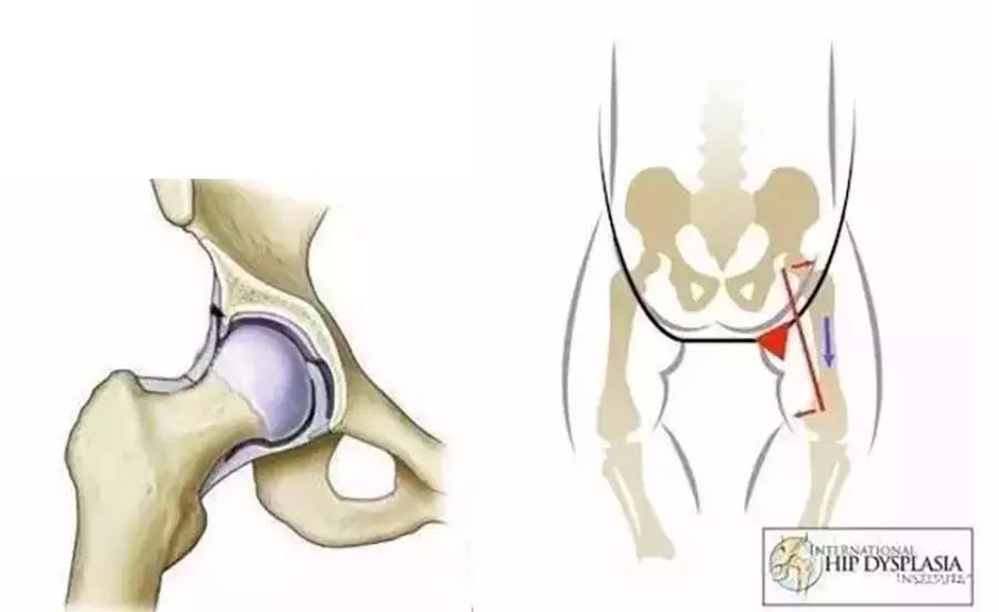 新生儿髋关节lla图片