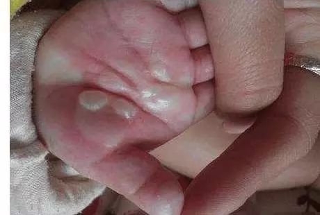 鱼鳞病婴儿的手图片