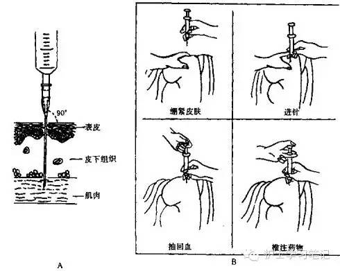 臀部肌肉注射定位法图片