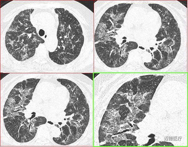 肺间质改变的基本ct表现