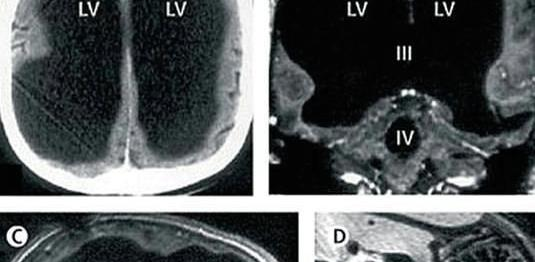 大脑|男子大脑神秘消失一大半, 依旧能正常生活