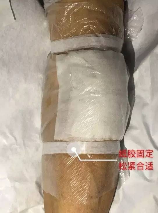 一敷一贴,造影剂外渗轻松搞定!