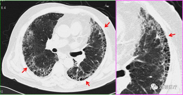肺间质改变的基本ct表现