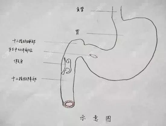 十二指肠球部解剖图图片