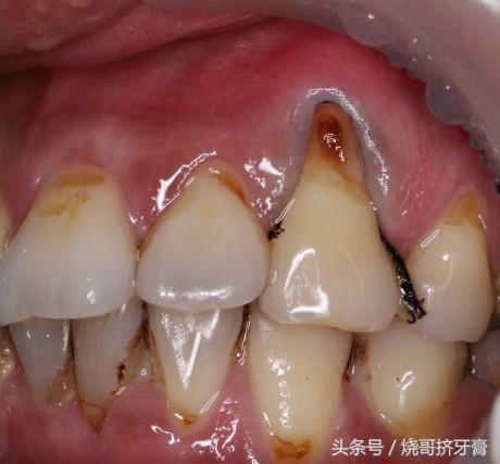 烂牙根一旦保不住,一定要及时拔掉,细菌滋生会引起牙龈组织病变,感染