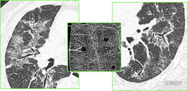 肺間質改變的基本ct表現