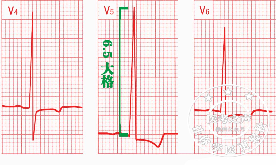 12秒)qrs波增寬心電圖:推理預激綜合徵