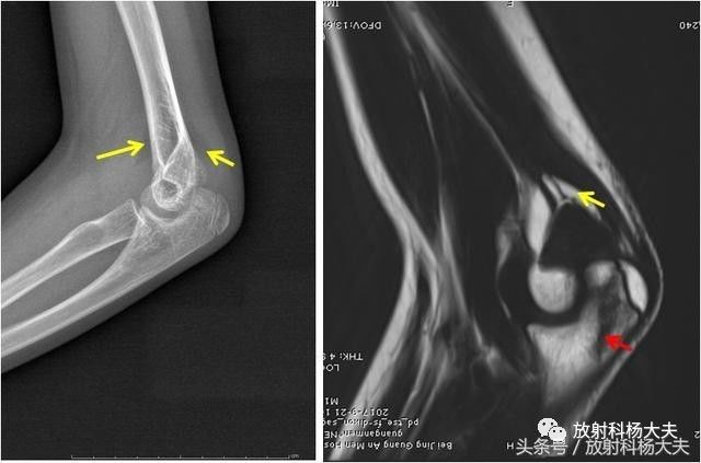 14歲女孩肘關節受傷,小大夫看不到骨折,最終老大夫經驗起了作用