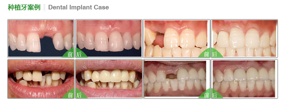 种植牙手术有何优缺点及种植牙前后对比图