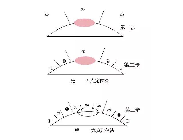 五点定位嫁接法图解图片