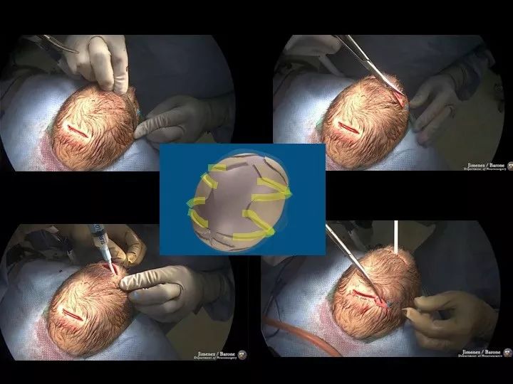颅缝早闭手术图片图片