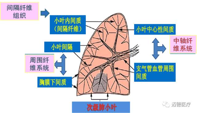 小叶中心间质与位于次级肺小叶周围的小叶间隔与胸膜下间质之间的桥梁