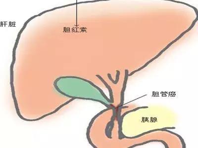 膽囊癌那些事兒