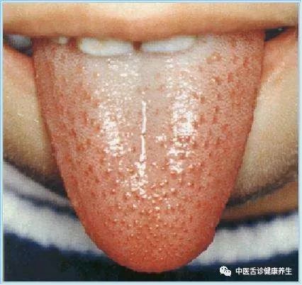 中医舌诊健康养生舌头提示你生病的11种症状