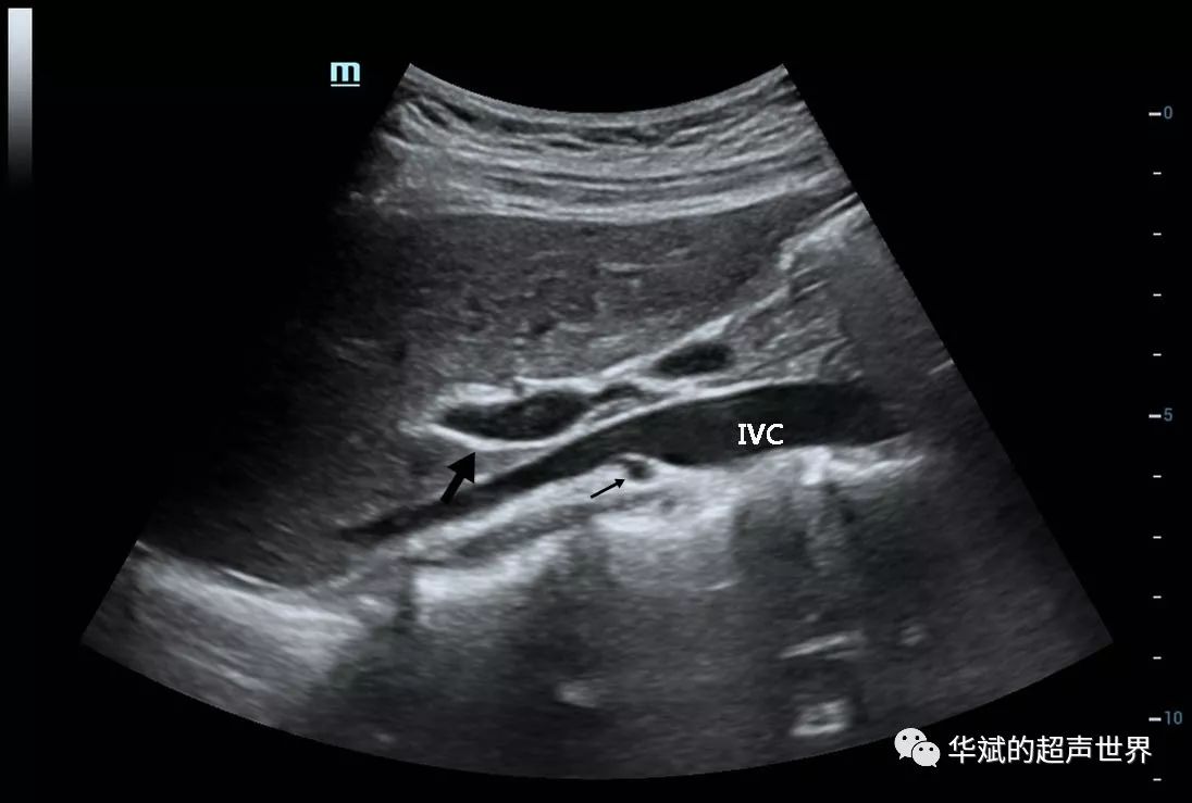 ivc:下腔靜脈;細箭頭:右腎靜脈;粗箭頭:門靜脈.