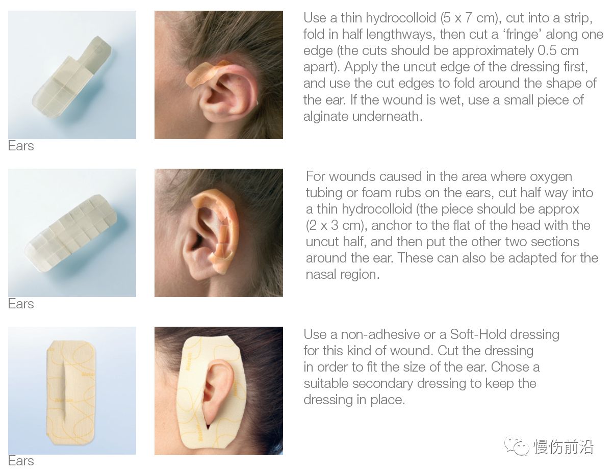 应用水胶体敷料和泡沫敷料对耳根,耳廓及周围伤口进行包扎