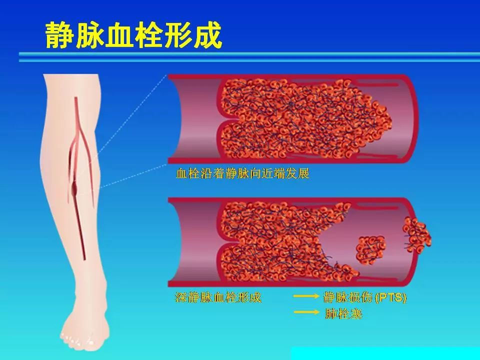 下肢静脉血栓的预防最全的预防措施