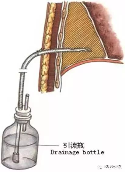 胸腔闭式引流结构图图片
