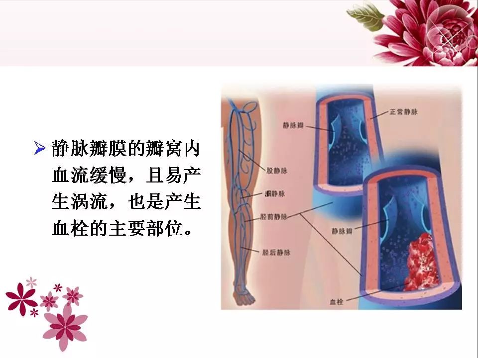 下肢静脉血栓解剖图图片