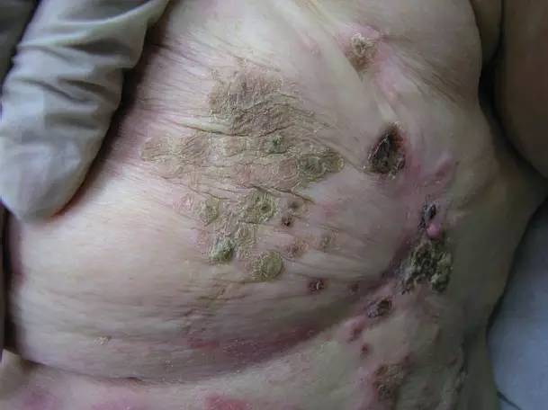 乳腺癌的中期症状照片图片
