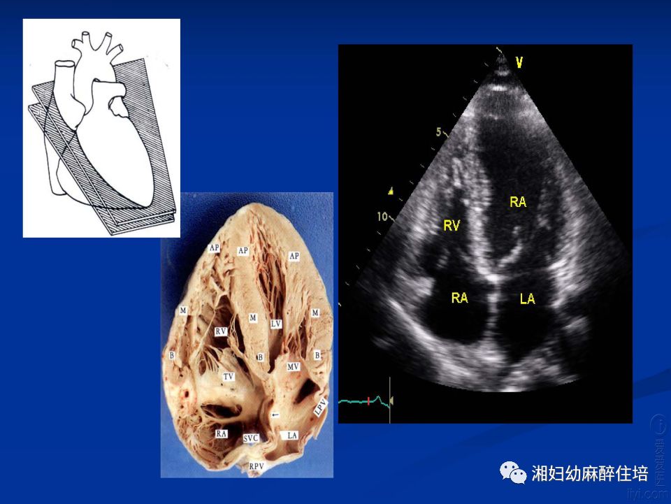 肺静脉超声位置示意图图片