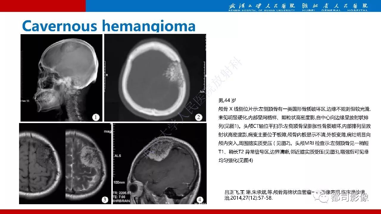 颅骨囊肿图片