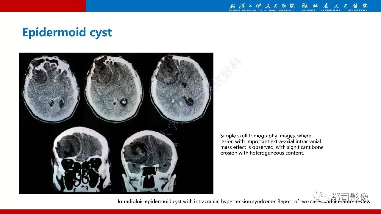 颅骨囊肿图片