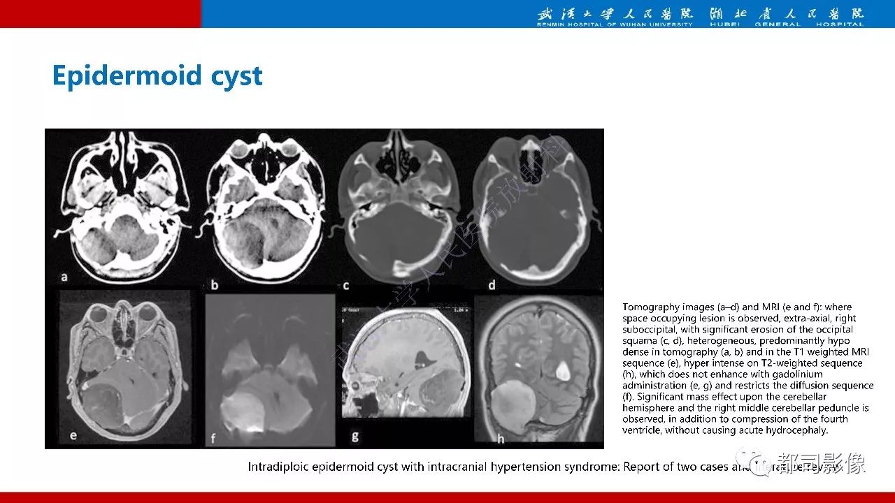 颅骨囊肿图片
