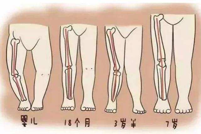 寶寶肋外翻,o型腿,x型腿是缺鈣嗎?