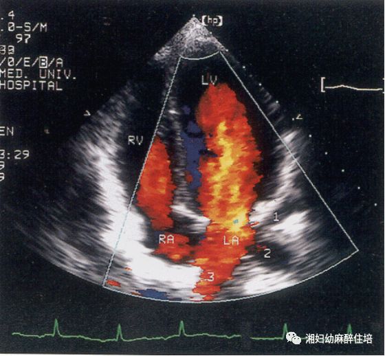 肺静脉超声位置示意图图片