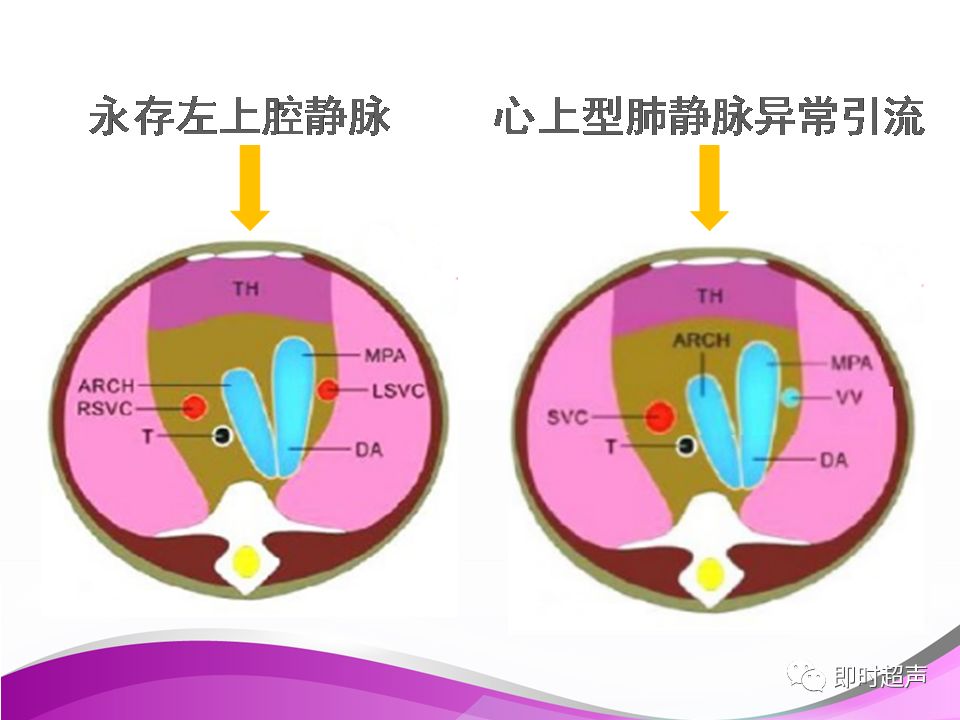 永存左上腔静脉示意图图片