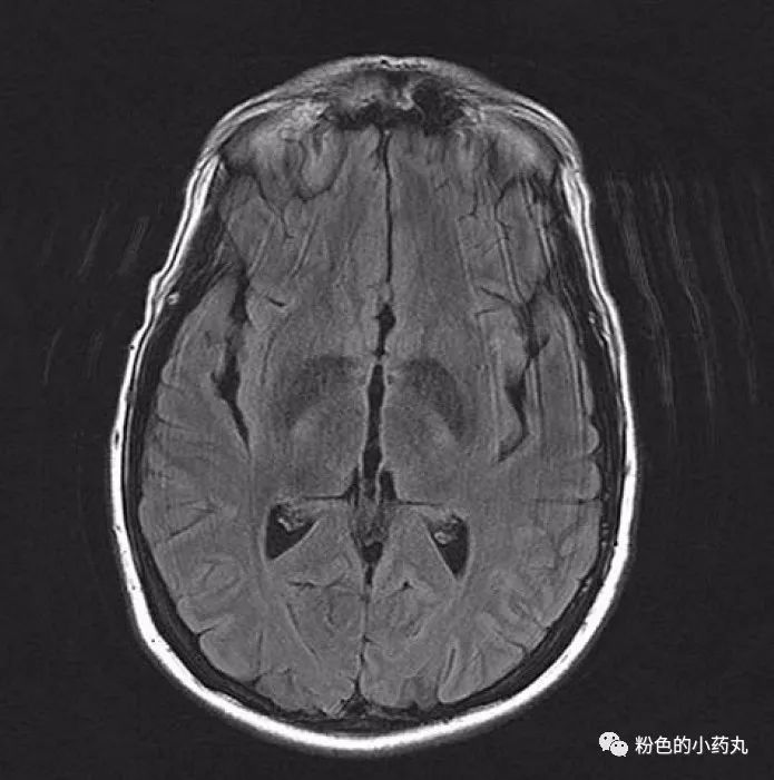 進行了頭磁共振成像(mri),結果顯示正常 (下圖)患者入院診斷為膽囊炎