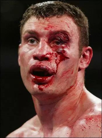 最可怕的拳击受伤这位拳手被打成外星人他更是被打出两个脑袋