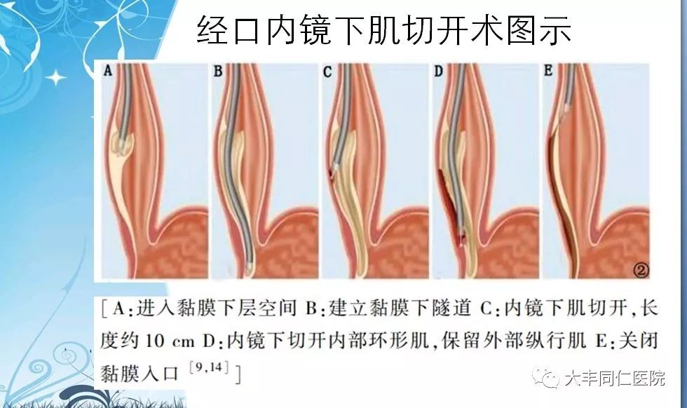 oddi括约肌痉挛图片