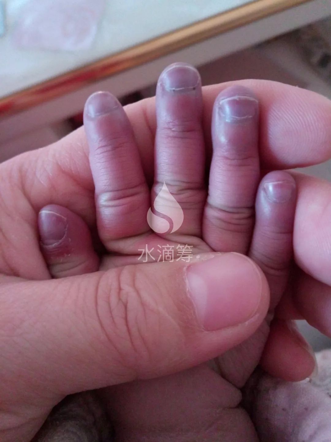 今年5月5号生的个女儿叫王昱佳,生下来发现孩子的指甲有点发紫,直到三