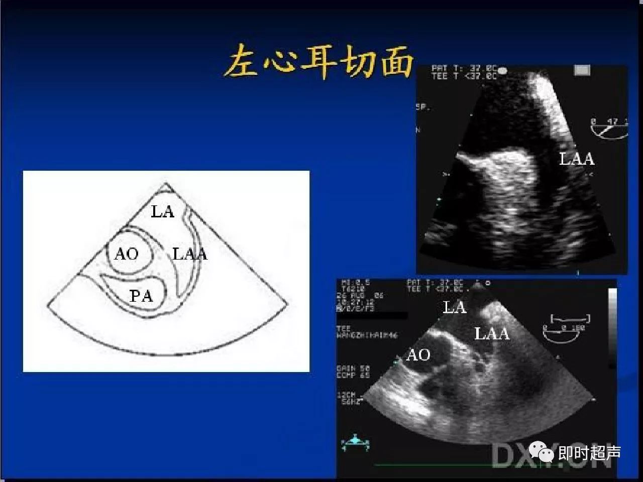 经食管超声心动图临床应用