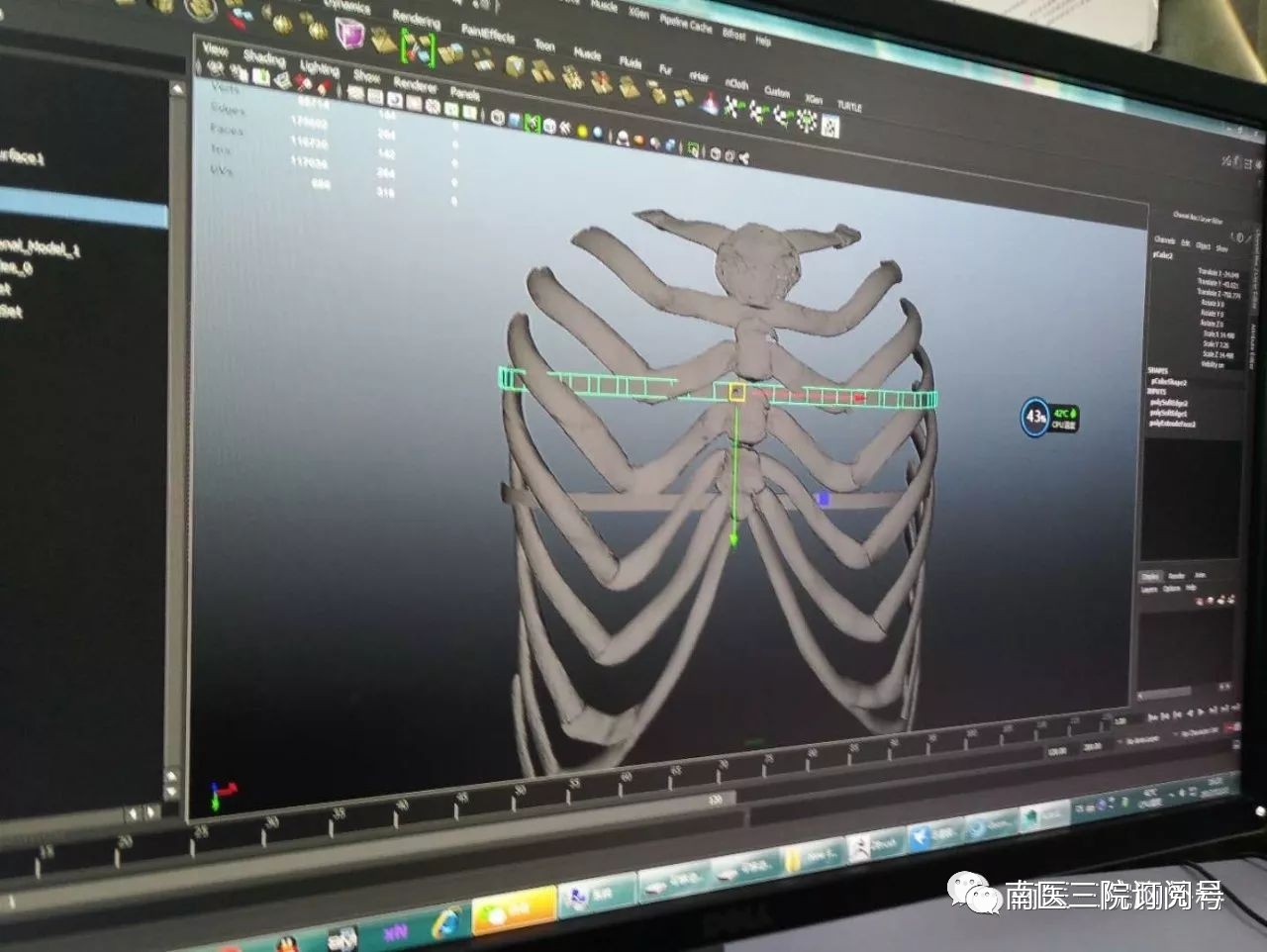 太神奇了不用開胸胸外科專家運用3d打印技術微創幫14歲少年撐起漏斗胸