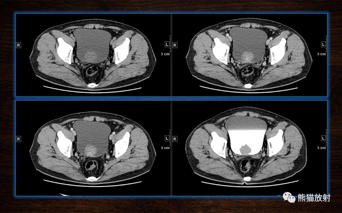 膀胱癌ct图片图片