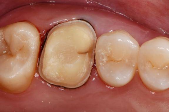 案例三:隱裂牙根管治療後椅旁cad/cam全冠修復
