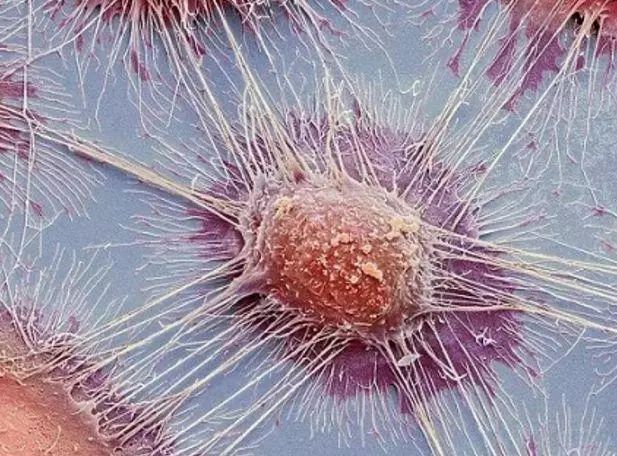 癌细胞真实图片显微镜图片