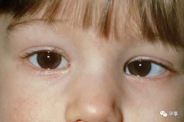 小孩对眼的图片症状图片