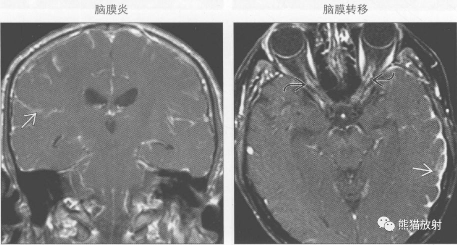 脑膜炎图片像什么样子图片