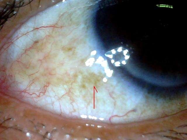 7眼白发蓝眼白发蓝,医学上叫蓝色巩膜,说明体内铁元素不足