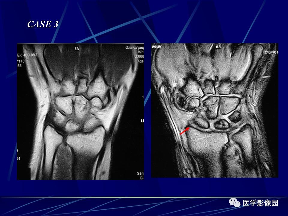 腕关节mri影像诊断丨影像天地