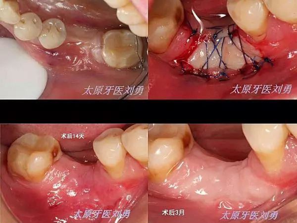 附着龈增宽术图解图片