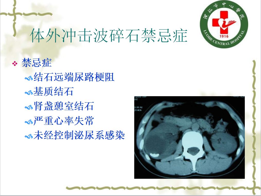 後尿道結石b型超聲x線檢查治療舟狀窩結石推擠或鉗出前尿道結石推擠