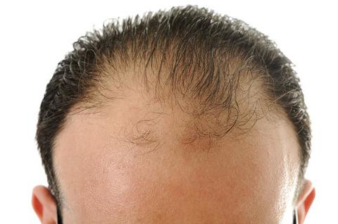 专家:男性脂溢性脱发3年以内能治好